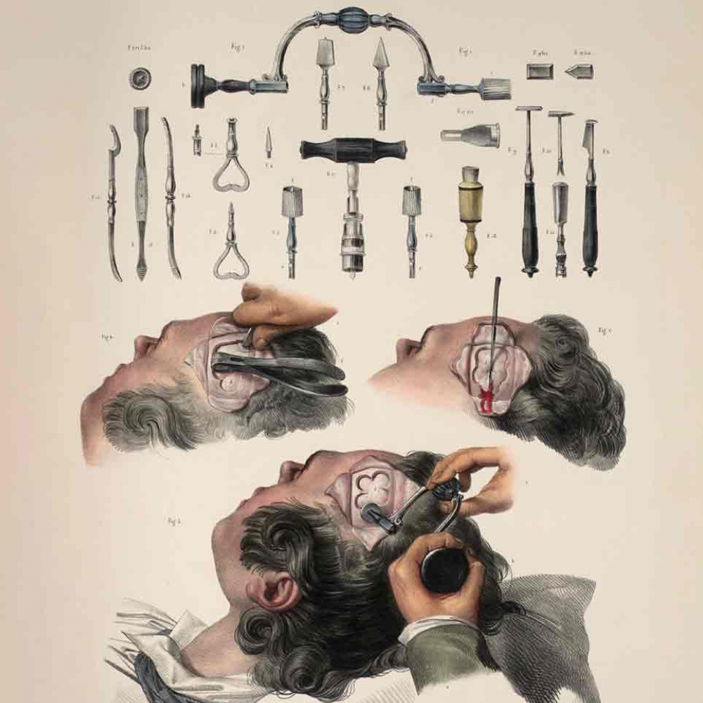 Surgery of the Past: Trepanning